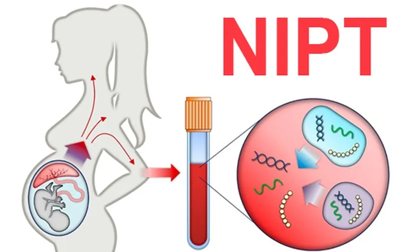 Độ mờ da gáy cao nhưng nipt bình thường thì em bé có sao không?