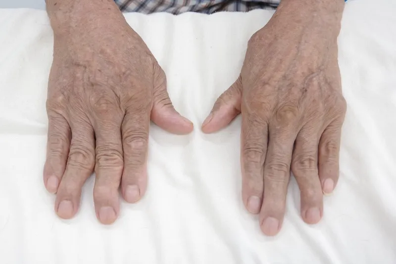 Sưng khớp ngón tay có thể xảy ra do nhiều nguyên nhân khác nhau như viêm, chấn thương hoặc viêm bao gân.