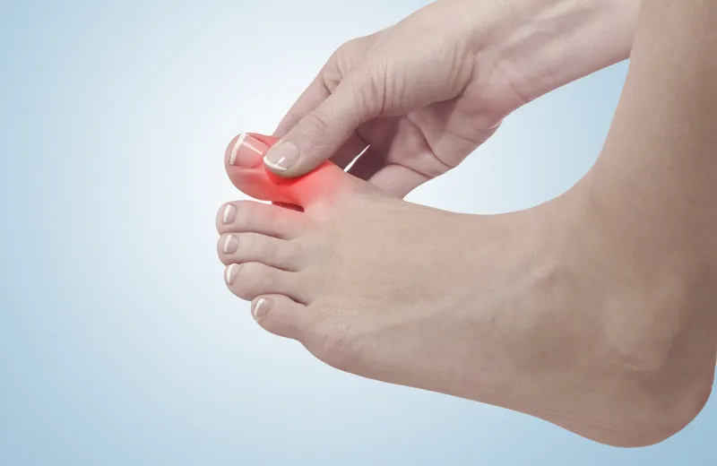 Cơn gút cấp thường bùng phát đột ngột ở khớp ngón chân cái với biểu hiện sưng đỏ, đau nhức dữ dội 
