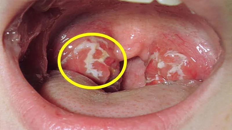 Nội soi là kỹ thuật quan trọng giúp phát hiện sớm các tổn thương tại vòm họng