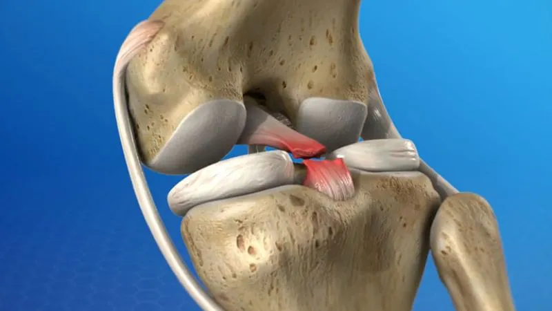 Hình minh họa cấu trúc khớp gối với hệ thống dây chằng bị đứt