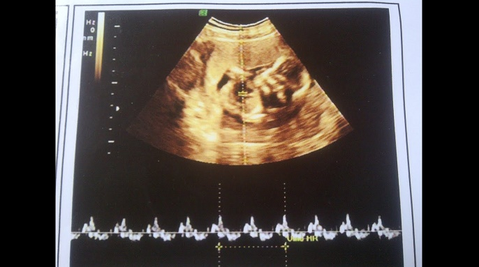 Hình ảnh siêu âm thai 7 tuần tuổi: những thông tin quan trọng cho mẹ bầu