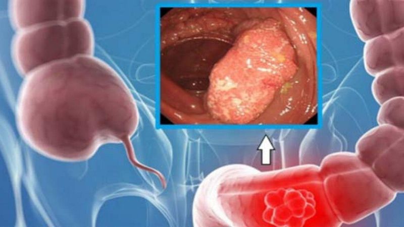 Hình minh họa nội soi giúp đưa ra hình ảnh chính xác giúp bác sĩ có phác đồ điều trị thích hợp 