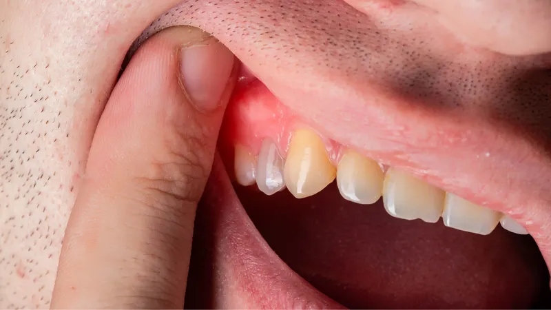 Một số tổn thương niêm mạc có thể hình thành các cục nhỏ trong khoang miệng