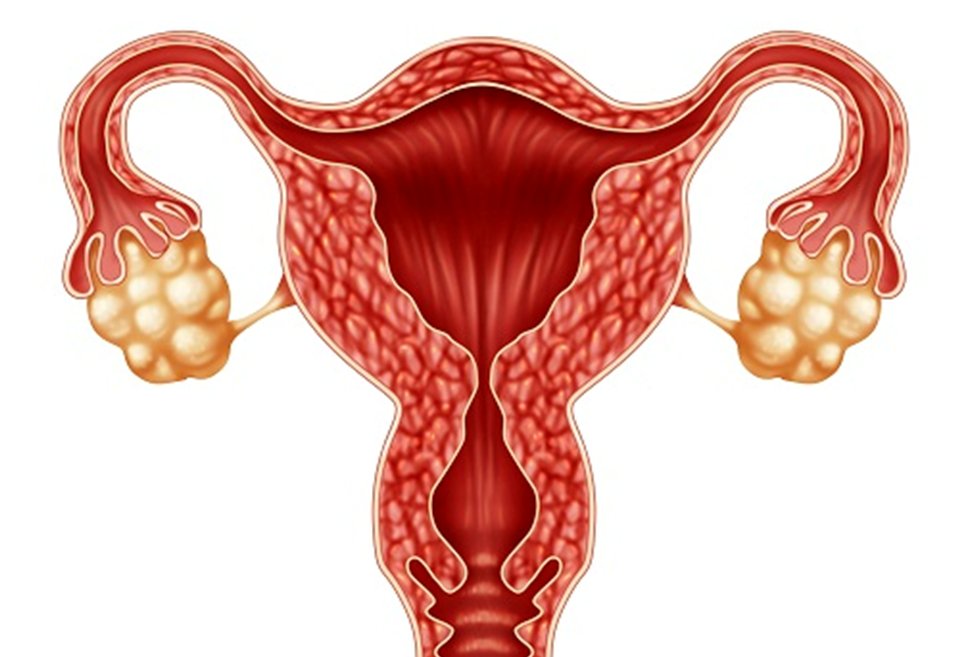 pcos