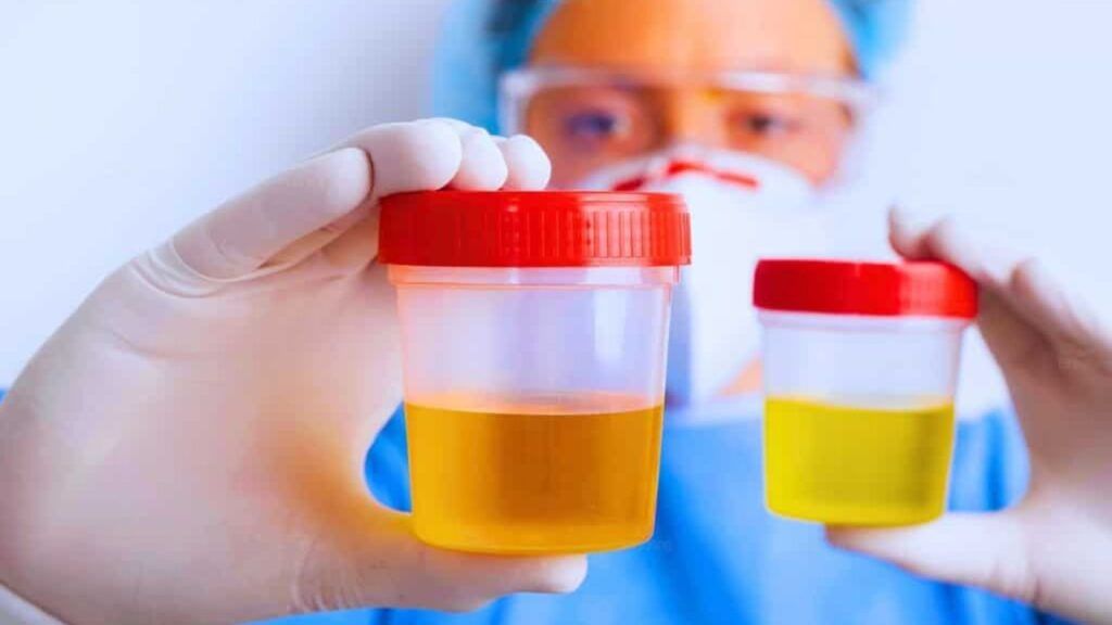 Nước tiểu màu vàng đậm ở nữ có sao không?