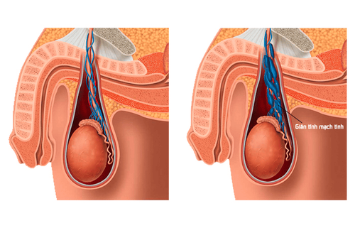 Giãn tĩnh mạch thừng tinh (Varicocele) 