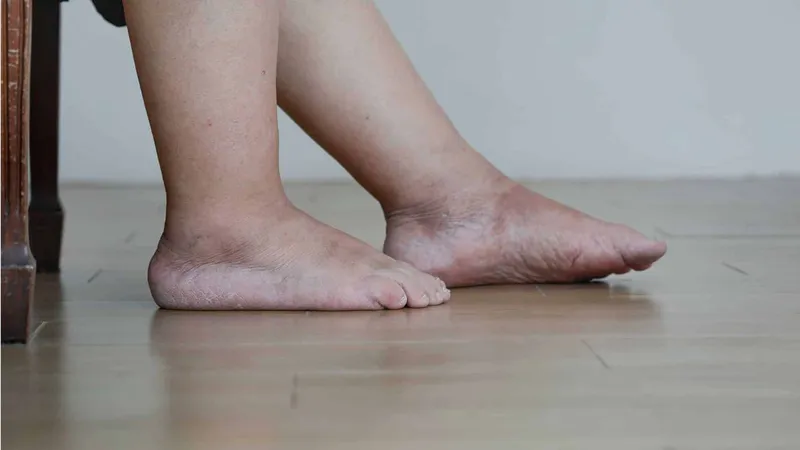 Theo dõi cân nặng hằng ngày là cách đơn giản nhất để phát hiện sớm tình trạng tích dịch âm thầm 