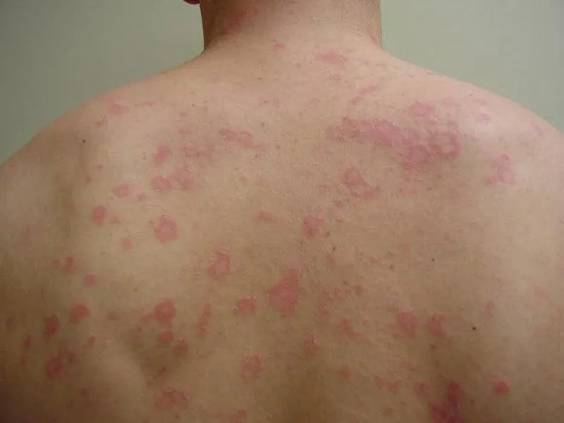 Hình ảnh mảng báo trước và các nốt phát ban nhỏ lan rộng trên thân mình