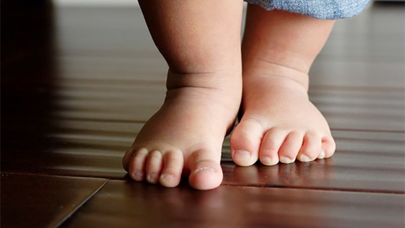 Cấu trúc vòm móng chân sụp đổ kéo theo sự lệch trục của toàn bộ hệ thống cơ xương khớp lên đến cột sống