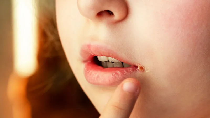 Trẻ em là đối tượng dễ bị chốc mép do thói quen chảy nước dãi và hệ miễn dịch chưa hoàn thiện 