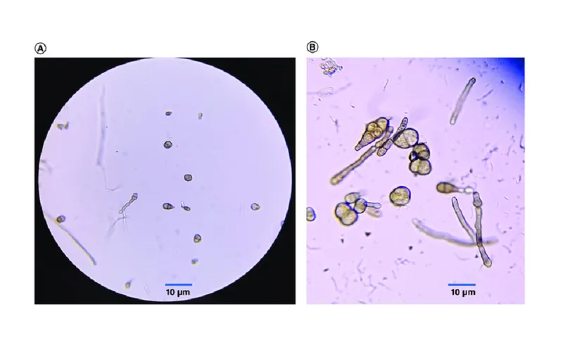 Xét nghiệm vi nấm soi tươi: tìm hiểu chi tiết và phương pháp điều trị bệnh