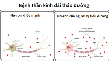 Bệnh lý thần kinh do tiểu đường