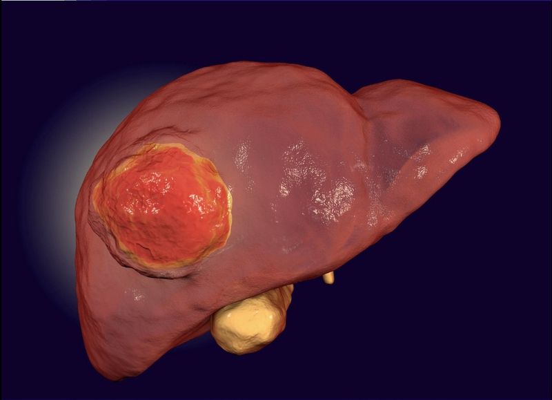 Minh hoạ về tình trạng mắt bị vàng do viêm gan nặng