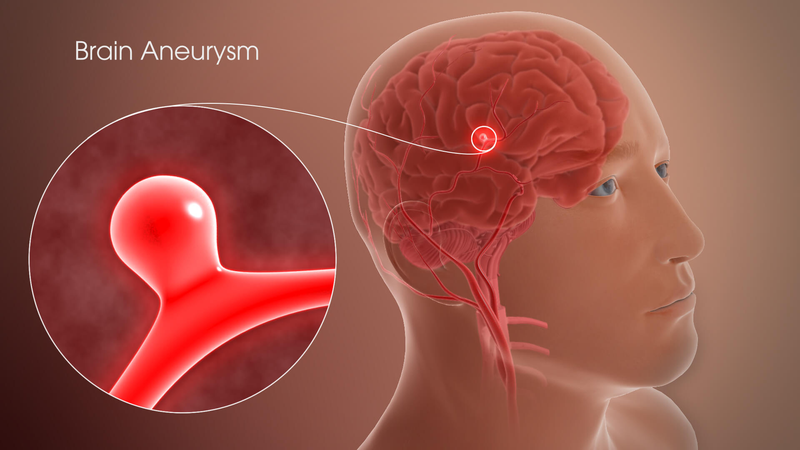 Hình minh họa MRI và nghiệm pháp lâm sàng giúp chẩn đoán liệt dây thần kinh số 4