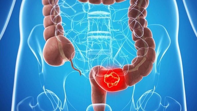 Hình minh họa biến chứng ở bệnh lý ung thư đại tràng 