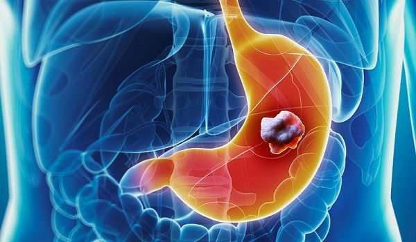 Ợ nóng và ợ chua là những dấu hiệu phổ biến của trào ngược dạ dày