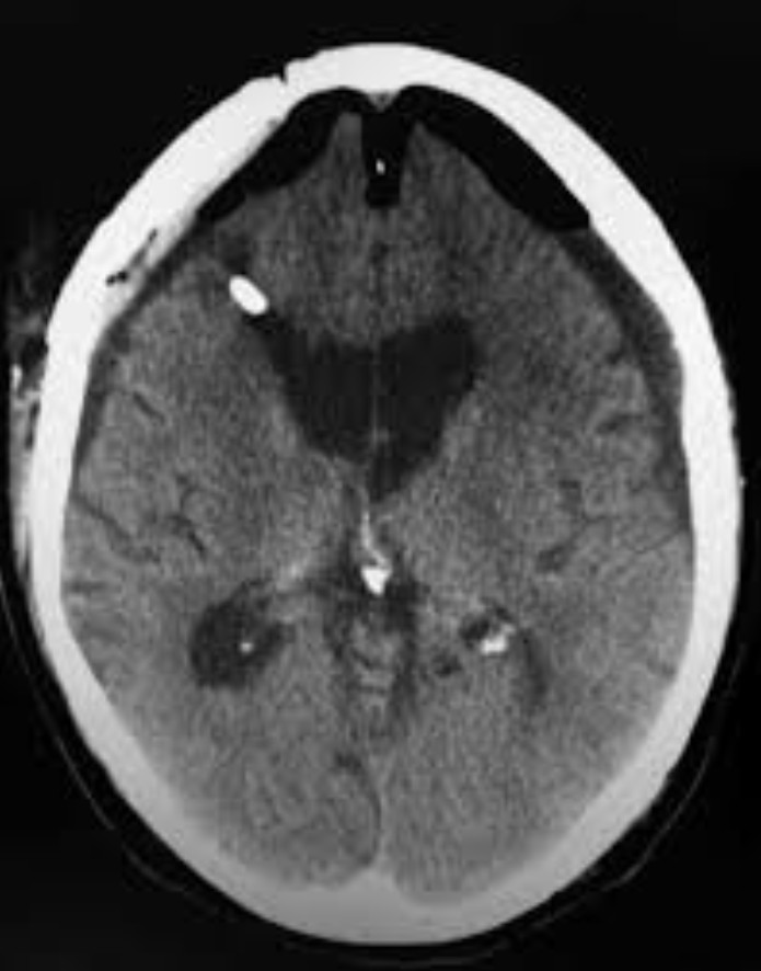 Hình ảnh u nang màng nhện não