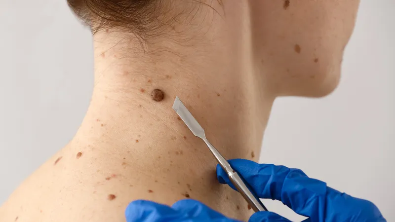 Thăm khám da liễu định kỳ giúp phát hiện sớm các tổn thương tiền ung thư