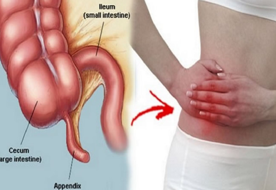 Viêm ruột thừa có tái phát không?