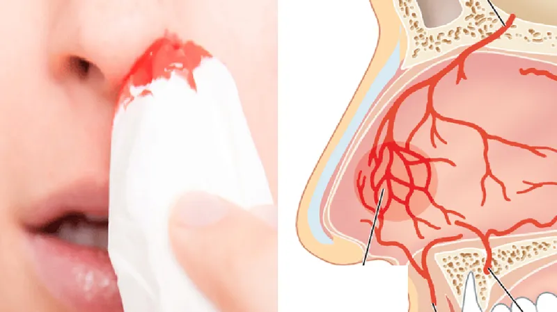 Vệ sinh mũi bằng nước muối sinh lý giúp duy trì độ ẩm niêm mạc và hỗ trợ phòng ngừa chảy máu cam