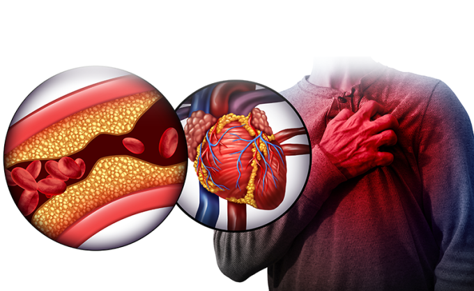 Xơ vữa động mạch vành do mỡ máu cao là nguyên nhân hàng đầu gây nhồi máu cơ tim 