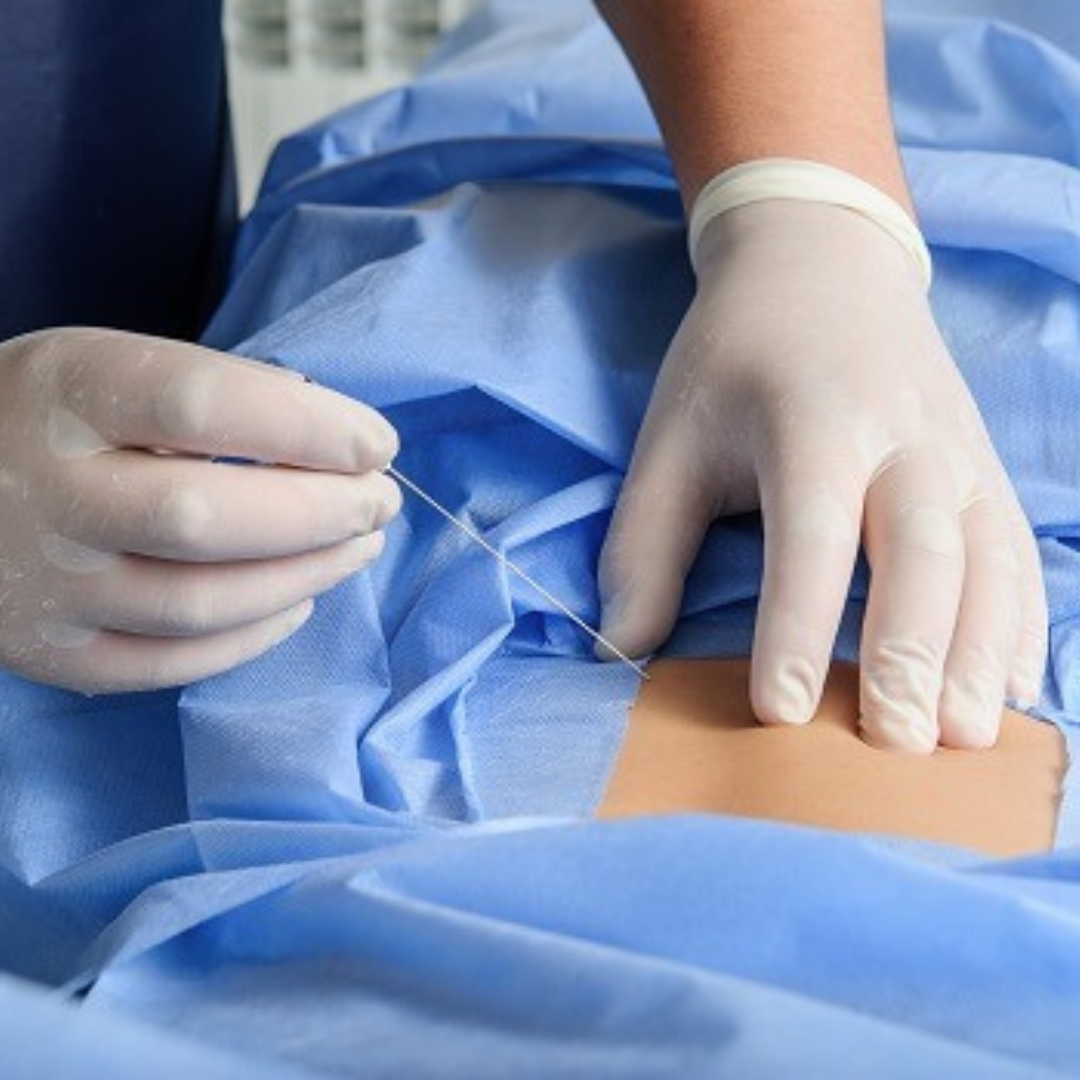 Xét nghiệm dịch não tủy có thể chẩn đoán viêm đa rễ dây thần kinh