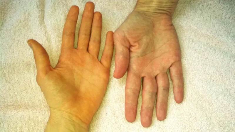 Hình ảnh minh họa tình trạng giãn đường mật do các yếu tố cản trở lưu thông