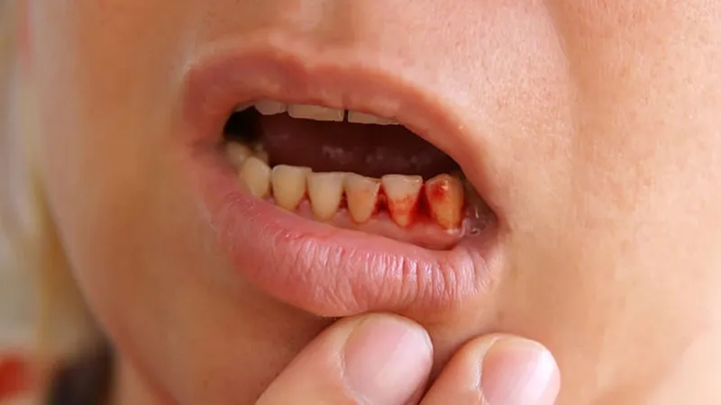 Bị viêm lợi uống thuốc gì cho nhanh hết? 