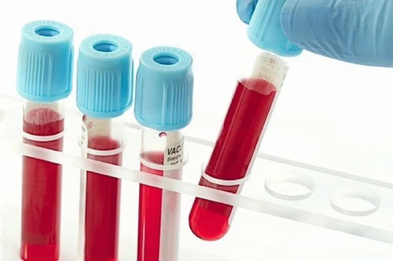 Xét nghiệm định lượng giúp theo dõi sát sao nồng độ virus viêm gan C trong máu 