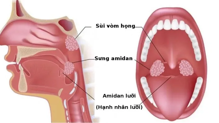 Áp xe quanh amidan: nguyên nhân, triệu chứng và điều trị hiệu quả
