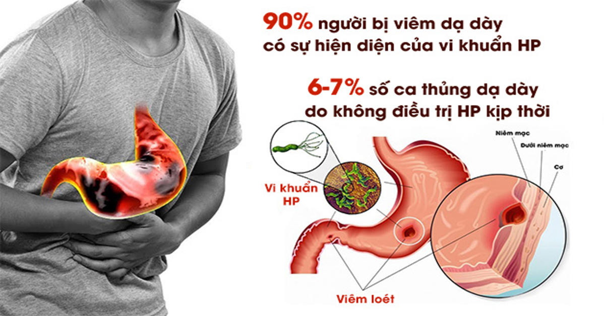 Nghi ngờ bị HP dạ dày? Cách phát hiện sớm đang được nhiều người lựa chọn trong năm nay 1 Nhiễm H.pylori (HP) là gì? Những điều cần biết về nhiễm H.pylori