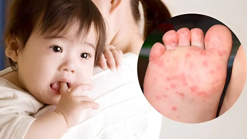 Bệnh tay chân miệng: triệu chứng và cách phòng ngừa