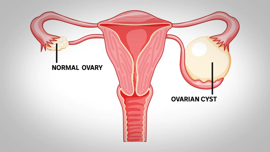 Nguyên nhân chính xác của u bì buồng trứng vẫn chưa được xác định rõ ràng