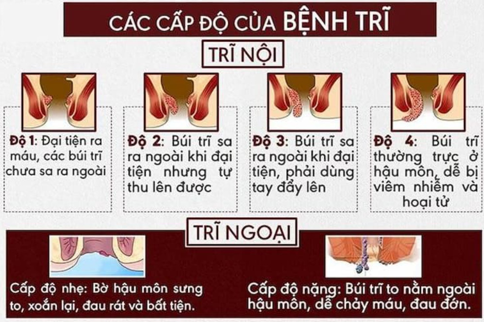 Cấp độ của bệnh trĩ