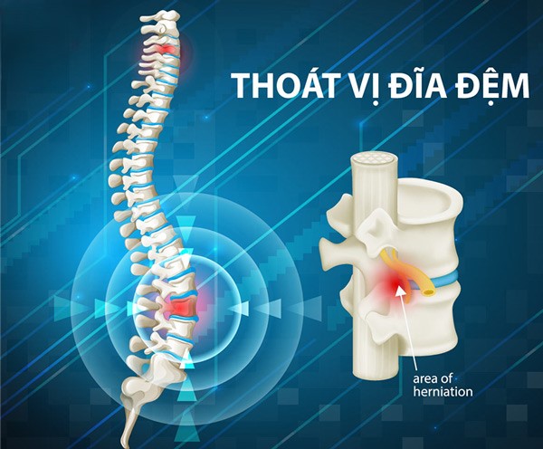 Thoát vị đĩa đệm là một biến chứng phổ biến của thoái hóa cột sống