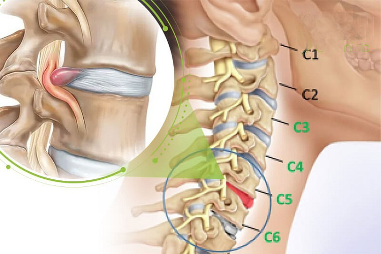 Thoát vị đĩa đệm cột sống cổ gây ra đau cổ