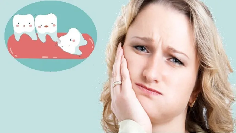 Mọc răng khôn có thể gây sưng nướu và sưng má do kích thích mô mềm