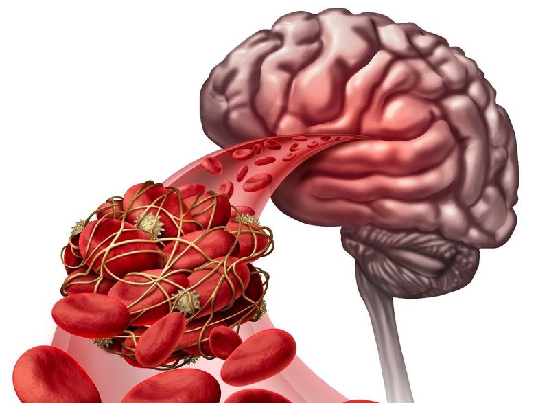 Tổn thương vùng não điều khiển ngôn ngữ là nguyên nhân chính gây khó nói sau tai biến