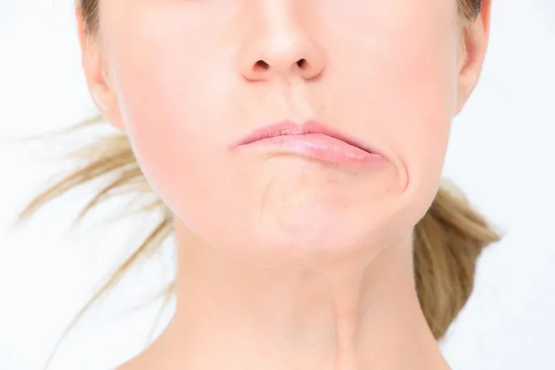 Méo miệng và yếu nửa người là những dấu hiệu điển hình nhất của tai biến 