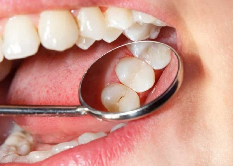 Ê buốt và đau khi nhai là dấu hiệu điển hình của tình trạng răng bị nứt 