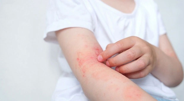 Cách giảm ngứa khi bị viêm da