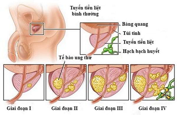 Ung thư tuyến tiền liệt có 4 giai đoạn