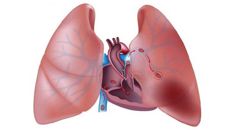 Hình minh họa bệnh lý phổi
