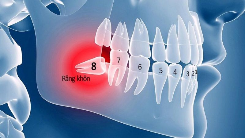 Có phải ai cũng mọc răng khôn?