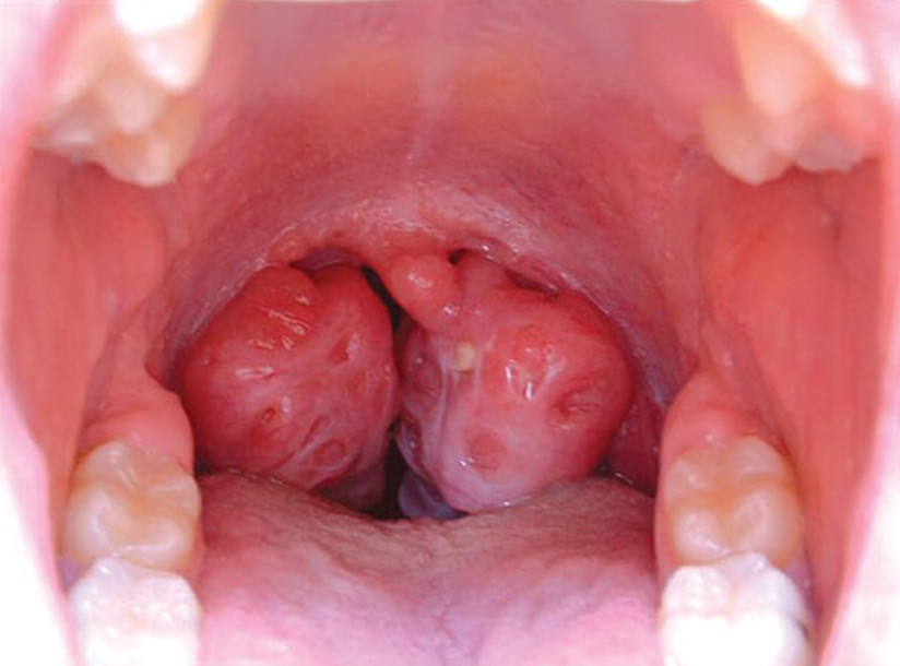 Triệu chứng ung thư vòm họng giai đoạn 3