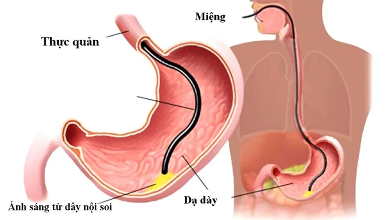 Kỹ thuật nội soi giúp bác sĩ quan sát trực tiếp tổn thương bên trong dạ dày 