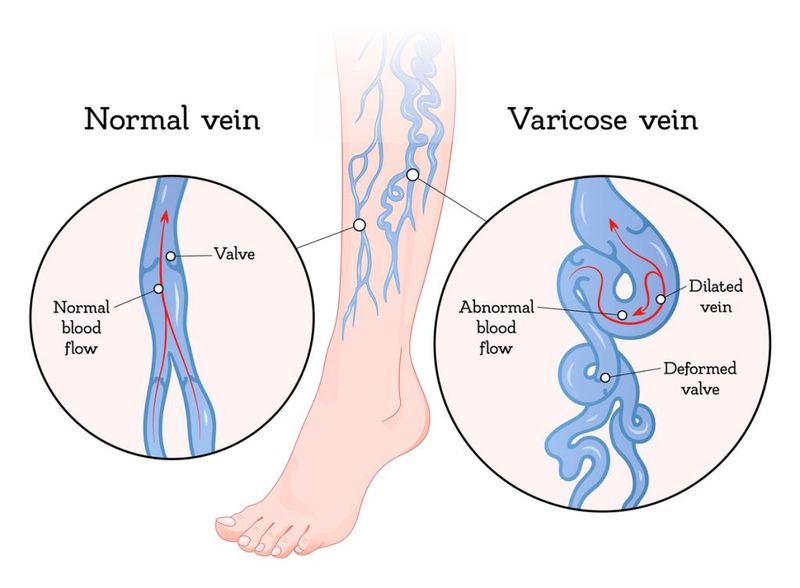 Các triệu chứng giãn tĩnh mạch và cách chăm sóc sức khỏe