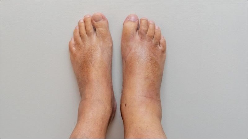 Những điều cần biết về phù nề