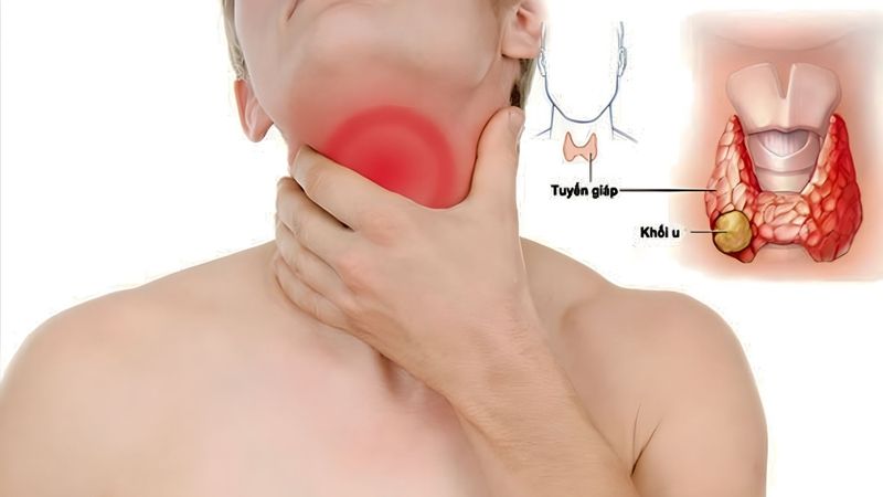 Siêu âm và chọc hút tế bào bằng kim nhỏ là những kỹ thuật then chốt trong chẩn đoán 